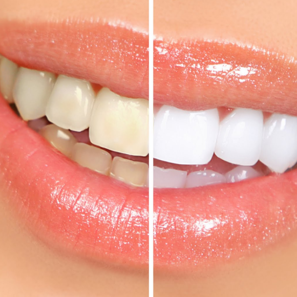 Clareamento Dental
