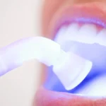 A imagem destacada ilustra o processo de clareamento dental, destacando os benefícios de um sorriso mais brilhante e saudável. Ela transmite a importância de adotar práticas de cuidado, como evitar alimentos que mancham os dentes e manter uma boa higiene bucal, para prolongar os resultados do clareamento e garantir um sorriso radiante por mais tempo. A imagem reflete a ideia de que, com cuidados apropriados, o clareamento dental pode trazer mais confiança e um sorriso mais luminoso