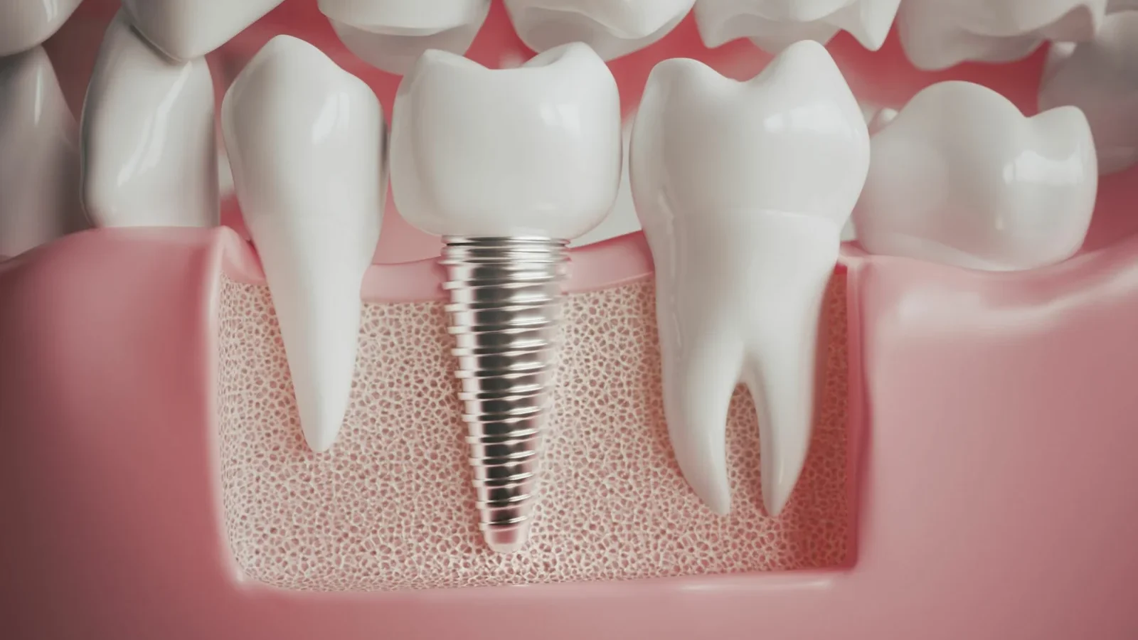 A imagem destacada ilustra os benefícios dos implantes dentários, destacando sua capacidade de restaurar o sorriso de forma natural e duradoura. Ela enfatiza que os implantes, fixados no osso da mandíbula, substituem a raiz do dente perdido e oferecem uma solução eficaz para melhorar a mastigação, prevenir a perda óssea e devolver a confiança no sorriso. A imagem transmite a ideia de que os implantes dentários são uma escolha definitiva para quem busca um sorriso completo